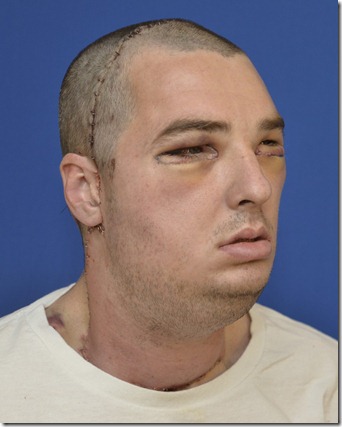 ричард норрис-после операции