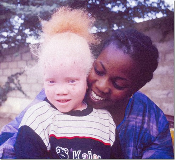 African Albino Foundation (5)