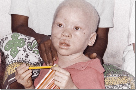 African Albino Foundation (6)
