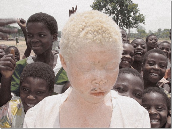 African Albino Foundation (7)