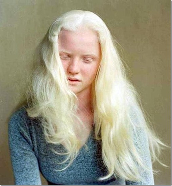 albinism_005